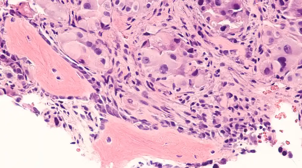 Kemik Metastazında Yeni Tedavi Yaklaşımları