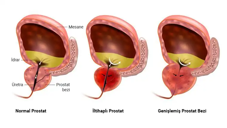 prostat nedir