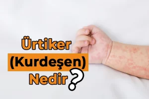 Ürtiker (Kurdeşen) Nedir?