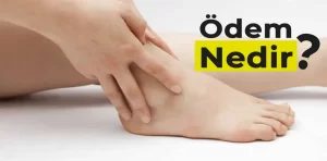 Ödem Nedir?