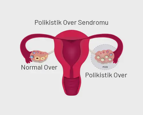 polikistik-over-sendromu 1