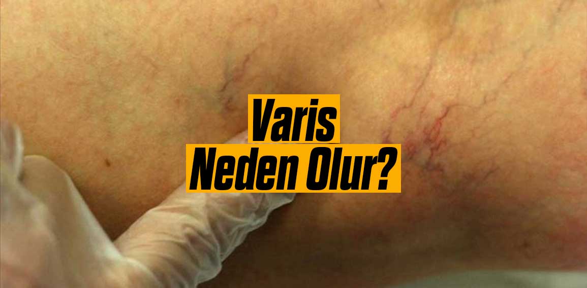 “Varis,” vücuttaki damarların genişlemesi