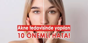 Akne tedavisinde yapılan 10 önemli hata!