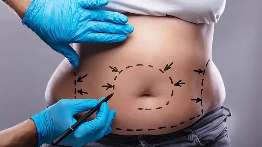 liposuction