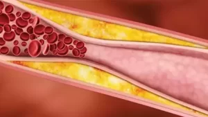 Trigliserid Nedir?