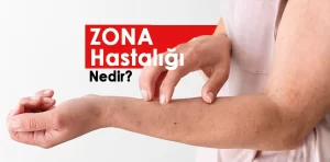 Zona Hastalığı nedir?