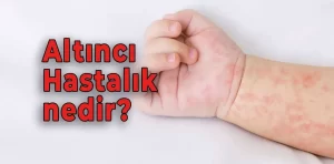 Altıncı Hastalık nedir?