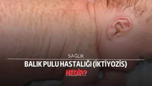 Balık Pulu Hastalığı (İktiyozis) Nedir?