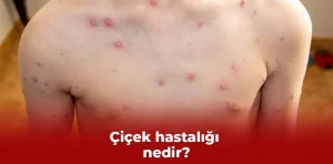 Çiçek hastalığı nedir?