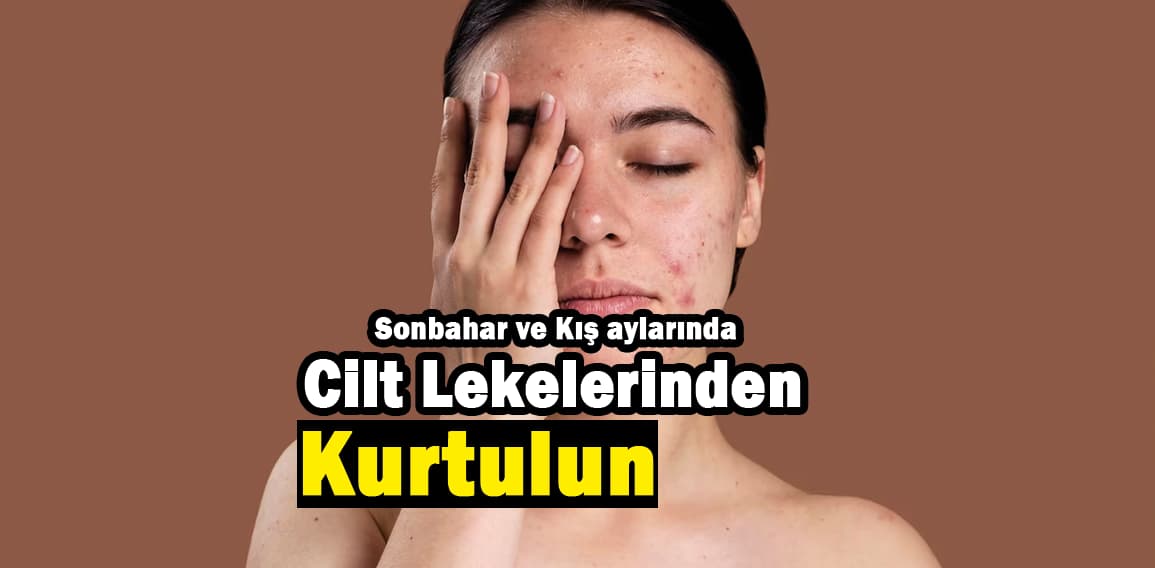 Cilt lekeleri, belirli bölgelerde