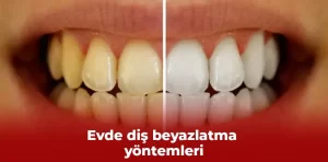 Evde diş beyazlatma yöntemleri