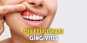 Diş eti iltihabı (Gingivitis) nedir?