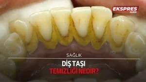 Diş taşı temizliği nedir, nasıl yapılır?