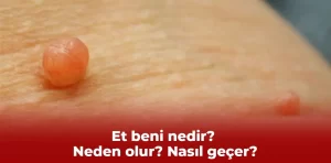 Et beni nedir? Neden olur? Nasıl geçer?