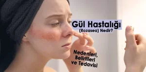 Gül Hastalığı (Rozasea) Nedir? Nedenleri, Belirtileri ve Tedavisi