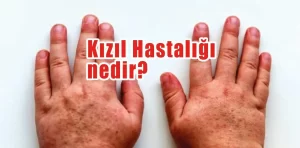 Kızıl hastalığı nedir?