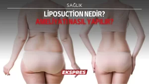 Liposuction nedir nasıl yapılır?