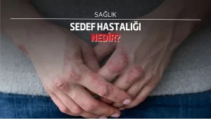 Sedef hastalığı nedir, belirtileri nelerdir?