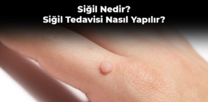 Siğil Nedir? Siğil Tedavisi Nasıl Yapılır?