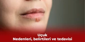 Uçuk: Nedenleri, belirtileri ve tedavisi