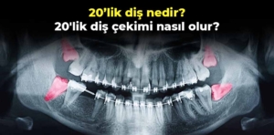 20’lik diş nedir? 20’lik diş çekimi nasıl olur?