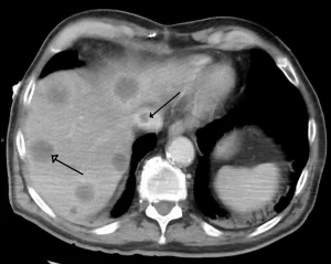 Budd Chiari Sendromu Nedir? Belirtileri Nelerdir?