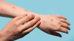 Maymun çiçeği virüsü (Mpox) nedir? Belirtileri nelerdir?