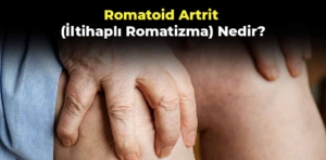 Romatoid Artrit (İltihaplı Romatizma) nedir? Belirtileri nelerdir?