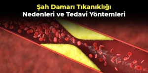 Şah Damarı Tıkanıklığı: Nedenleri ve Tedavi Yöntemleri