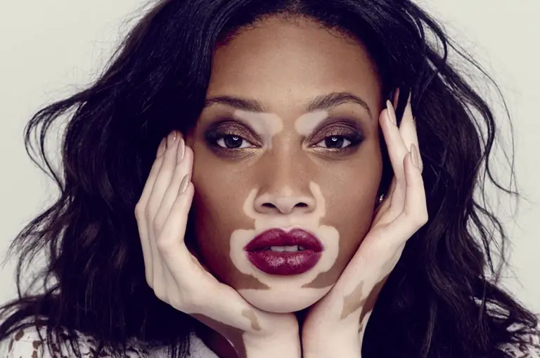 Vitiligo, deride beyaz lekelerin