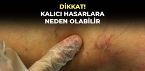 Önemsenmeyen bacak varisleri kalıcı hasarlara neden olabilir