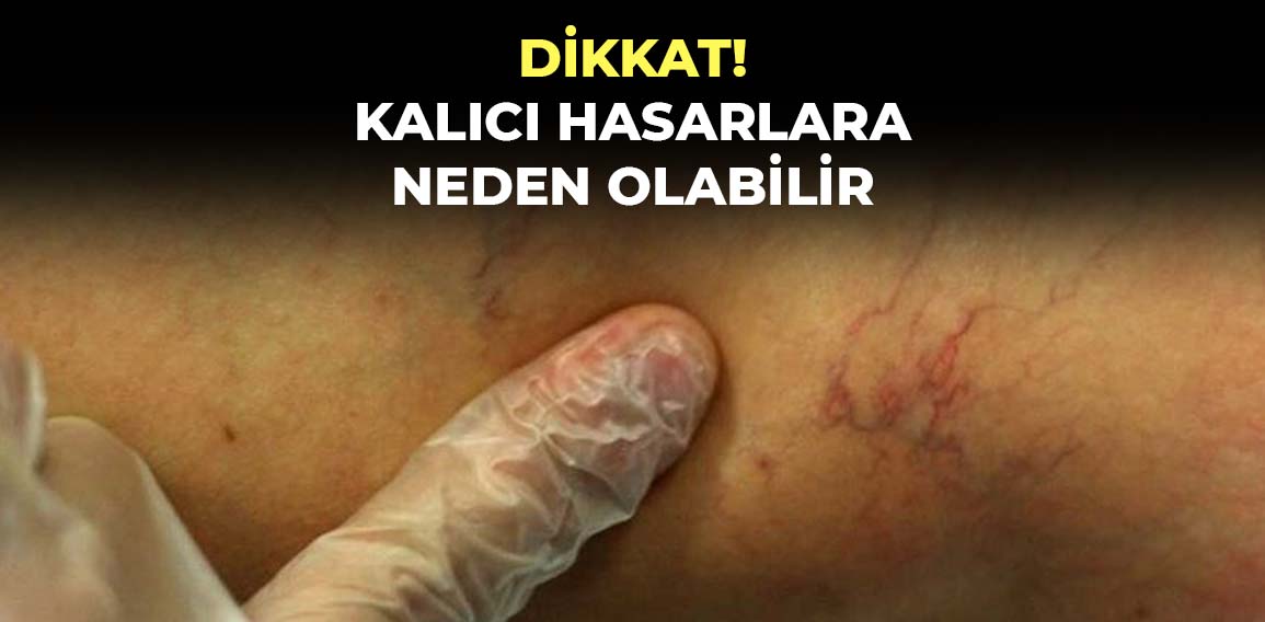 Bacak varisleri, toplardamarlarda kanın