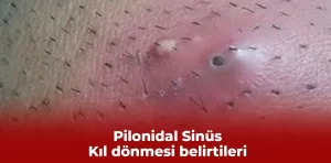 Kıl dönmesi belirtileri ve tedavisi ( Pilonidal Sinüs )