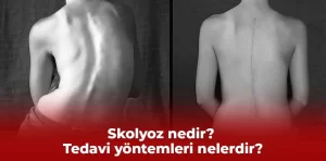 Skolyoz nedir? Tedavi yöntemleri nelerdir?