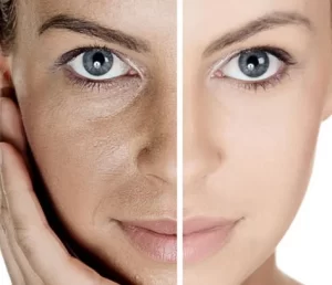 Işık Peeling uygulaması nedir?