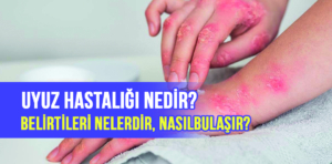 Uyuz hastalığı nedir, belirtileri nelerdir, nasıl bulaşır?