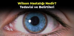 Wilson Hastalığı Nedir? Tedavisi ve Belirtileri