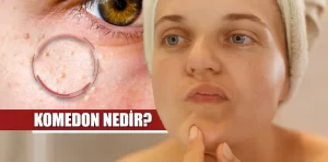 Komedon nedir?