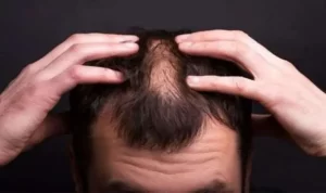 Alopesi üniversal nedir?