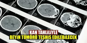 Kan tahliliyle beyin tümörü teşhis edilebilecek