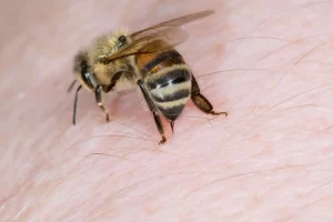 Arı alerjisi belirtileri, tanı ve tedavisi