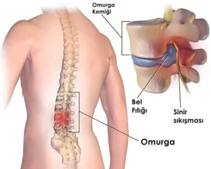 Bel fıtığı rehabilitasyonu nedir?