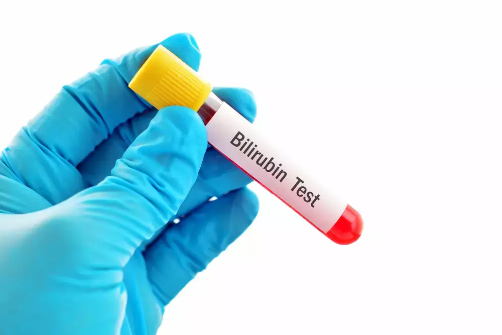 Bilirubin Nedir? Bilirubin, vücutta