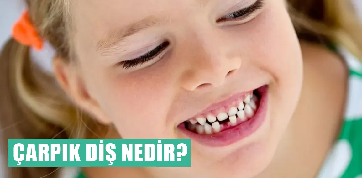 Çarpık diş nedir? Çarpık