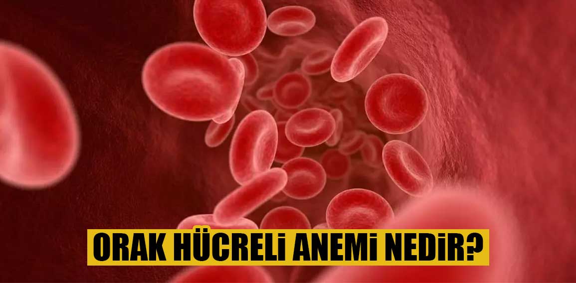 Orak hücreli anemi nedir?