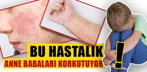 Beşinci hastalık nedir?