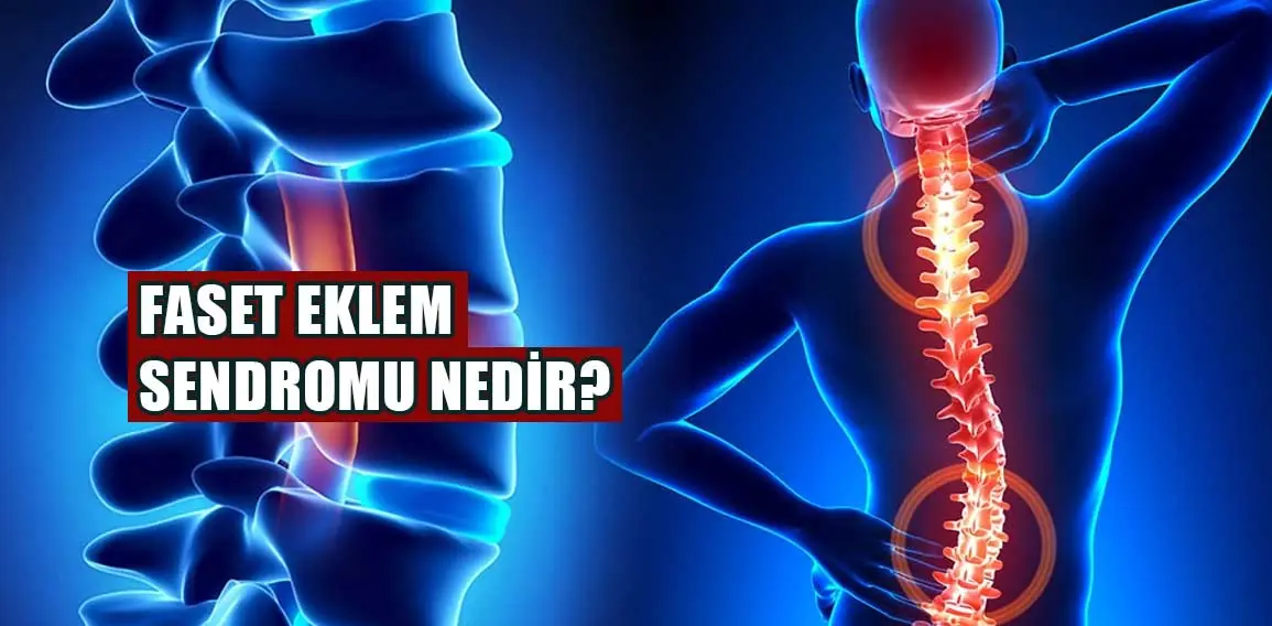 Faset eklem sendromu nedir?