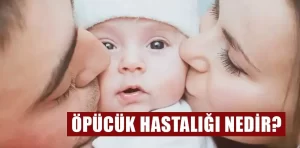 Öpücük hastalığı nedir?