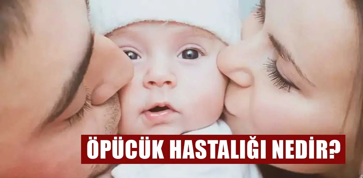 Öpücük hastalığı nedir? Öpücük