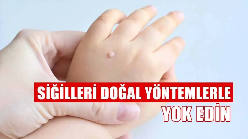 Siğilleri doğal yöntemlerle yok edin